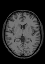 MRI Template - T1 Axial View