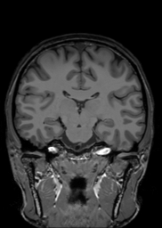 MRI Template - T1 Coronal View